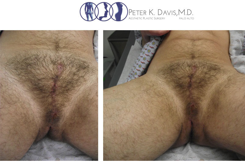 Post op nullification surgery from Dr Peter Davis. 